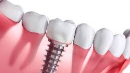 Clínica odontológica é condenada a pagar indenização após implante dentário mal sucedido