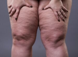 Lipedema: entre o que viraliza nas redes e o que é preciso esclarecer